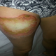 Image for article titled This Is What Happens When a Phone Explodes on Your Leg *GRAPHIC*